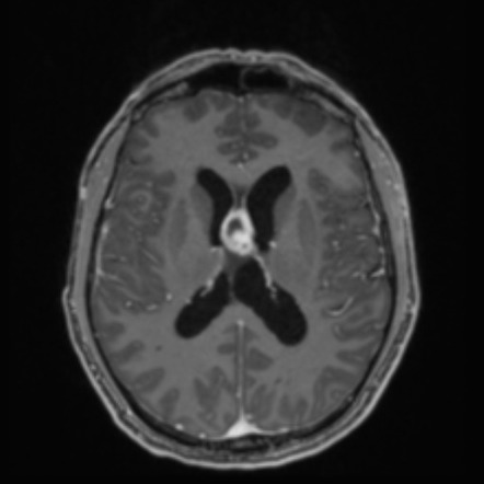 Primary Central Nervous System Posttransplant Lymphoproliferative ...