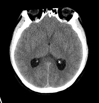 Post-transplant Lymphoproliferative Disorder (PTLD) | Radiology Case ...