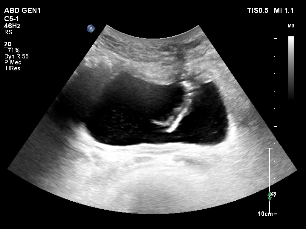 Fibrotic bands associated with chronic suprapubic catheterization ...