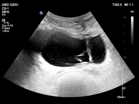 Fibrotic bands associated with chronic suprapubic catheterization ...