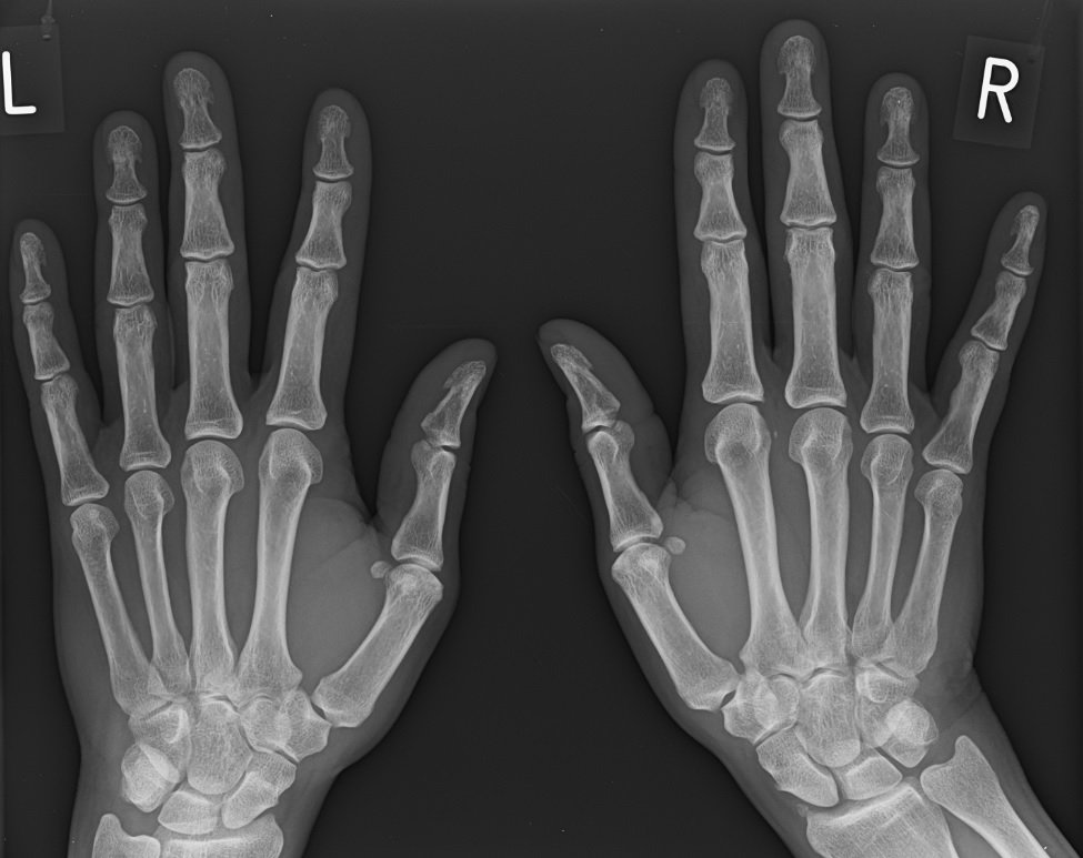 carpal-boss-image-radiopaedia