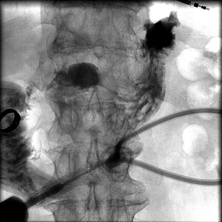 Buried bumper syndrome gastrostomy tube Image