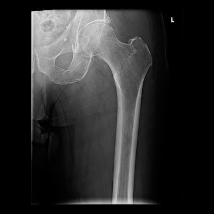 Occult intertrochanteric fracture | Image | Radiopaedia.org