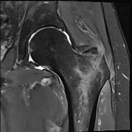 Bone marrow edema | Radiology Reference Article | Radiopaedia.org