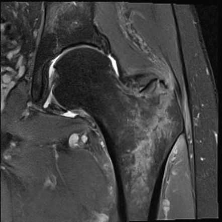 Proximal femoral fractures (summary) | Radiology Reference Article ...