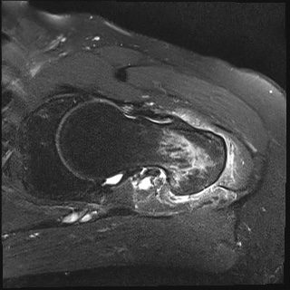 Occult intertrochanteric fracture | Image | Radiopaedia.org