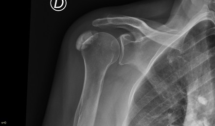 icd 10 subacromial bursitis right shoulder