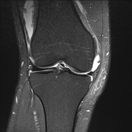 Anterior cruciate ligament and bucket handle meniscal tears | Radiology ...