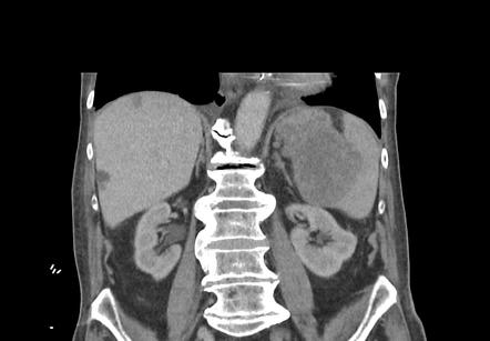 Malignant melanoma invading stomach and spleen | Image | Radiopaedia.org