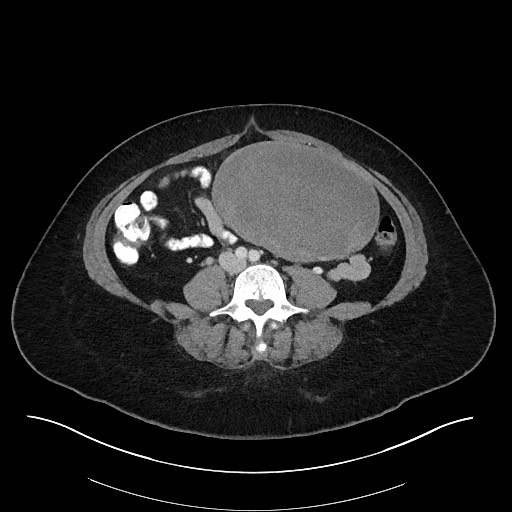 Intra Abdominal Desmoid Tumor Large Image 0834