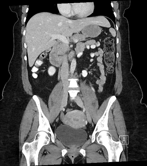 Intra Abdominal Desmoid Tumor Large Image 2717