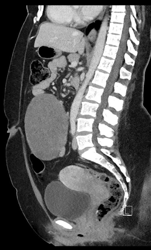 Intra Abdominal Desmoid Tumor Large Image 8604