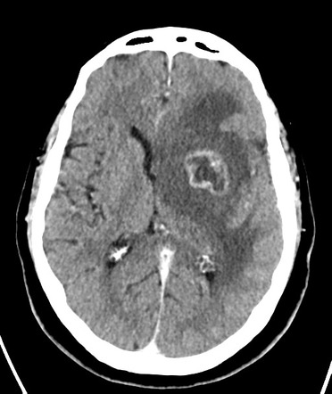 Glioblastoma | Image | Radiopaedia.org