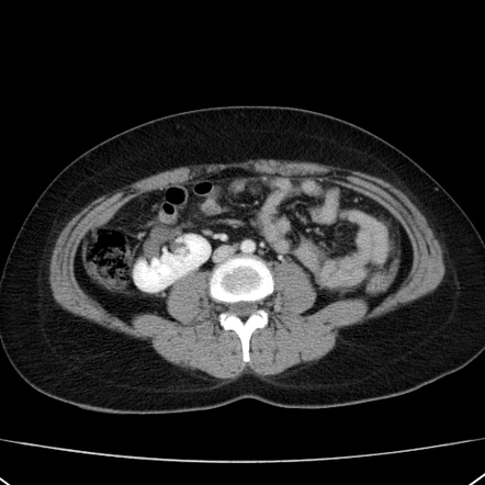 Malrotation of kidney | Image | Radiopaedia.org