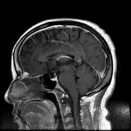 Cerebral cavernous malformation | Image | Radiopaedia.org