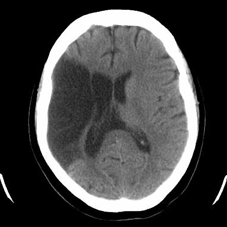 Chronic right cerebral infarct with Wallerian degeneration | Radiology ...