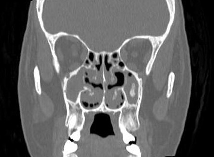 Intrasinus calcification | Radiology Reference Article | Radiopaedia.org