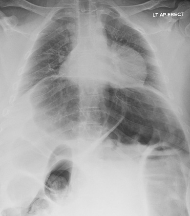 Pseudopneumoperitoneum | Radiology Case | Radiopaedia.org