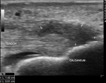 Foreign body - ankle | Image | Radiopaedia.org