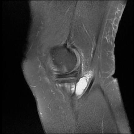 Pes Anserine Bursitis | Image | Radiopaedia.org