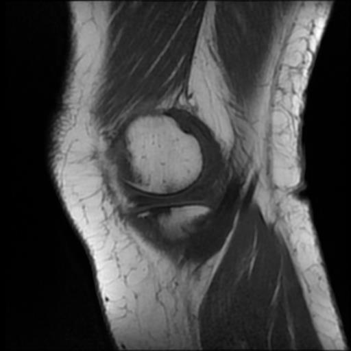 Pes Anserinus Bursitis Image Radiopaedia Org The Best Porn Website