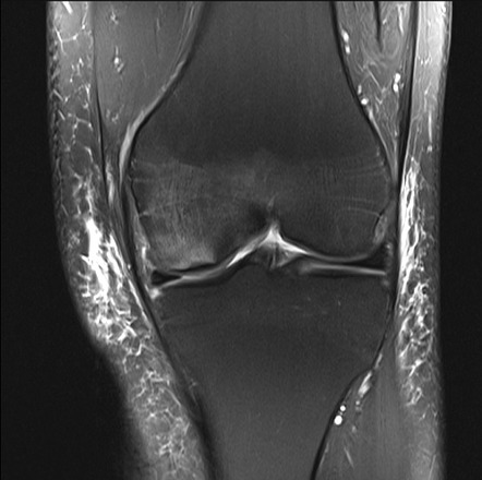 Femoral Subchondral Insufficiency Fracture Treated By Subchondroplasty Image Radiopaedia Org