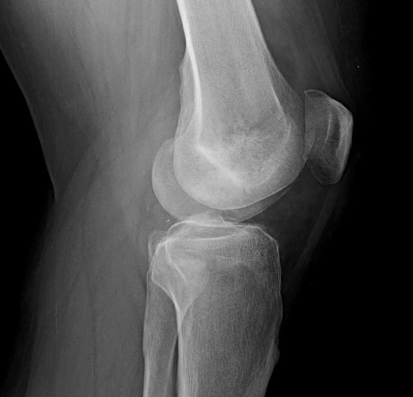 Femoral subchondral insufficiency fracture - treated by ...