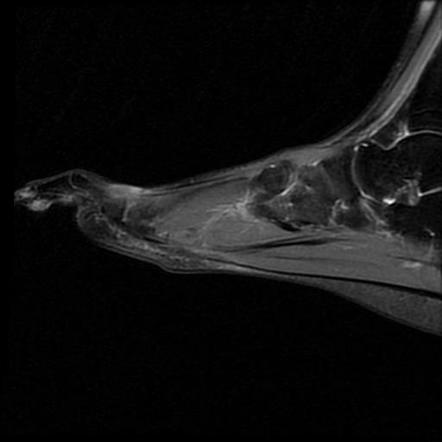 Accessory Navicular Syndrome Image Radiopaedia Org