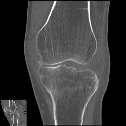 Meniscal calcification | Image | Radiopaedia.org