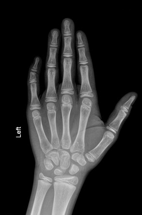 Clinodactyly | Radiology Case | Radiopaedia.org