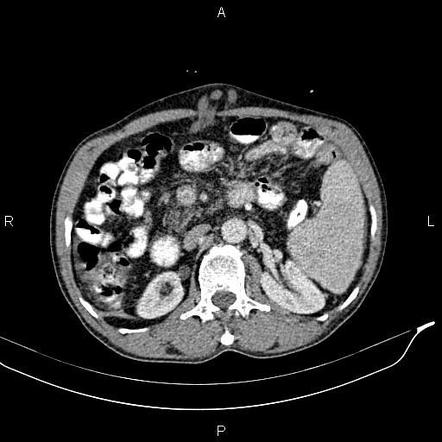 Caput medusae sign - portal hypertension | Image | Radiopaedia.org