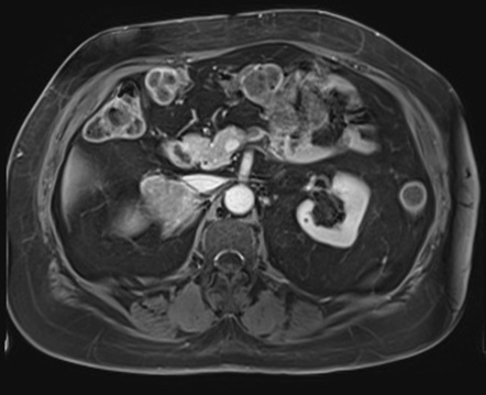 Adrenal cortical carcinoma | Image | Radiopaedia.org