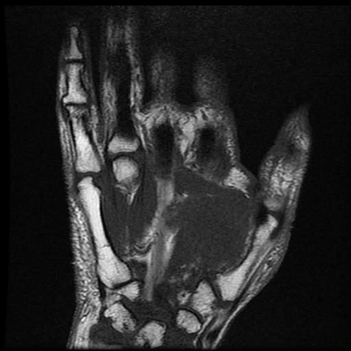 Subcutaneous hematoma - wrist (MRI) | Image | Radiopaedia.org