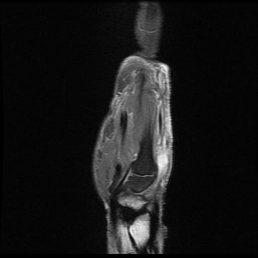 Subcutaneous hematoma - wrist (MRI) | Image | Radiopaedia.org