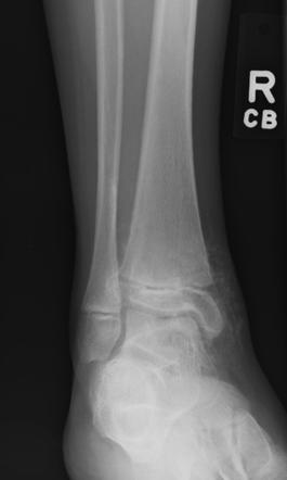 Dystrophic calcification | Image | Radiopaedia.org