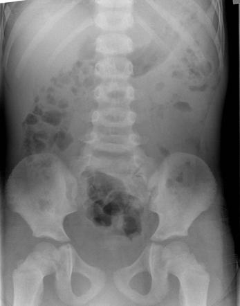 Sacral tumor with lung metastases | Radiology Case | Radiopaedia.org