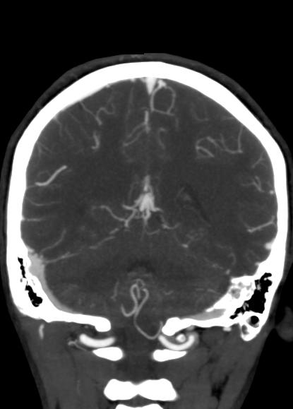 Developmental venous anomaly (DVA) - cerebellar | Image | Radiopaedia.org