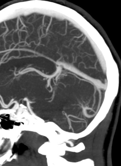 Developmental venous anomaly (DVA) - cerebellar | Image | Radiopaedia.org