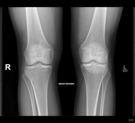 Prepatellar bursitis | Image | Radiopaedia.org