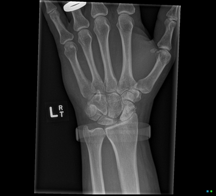 Scapholunate advanced collapse | Radiology Reference Article ...