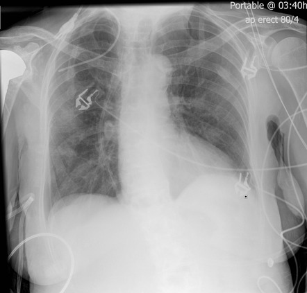 Misplaced jugular venous catheter in right subclavian | Radiology Case ...