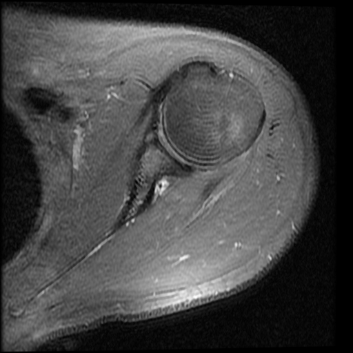 Bony Bankart lesion with Hill-Sachs | Image | Radiopaedia.org