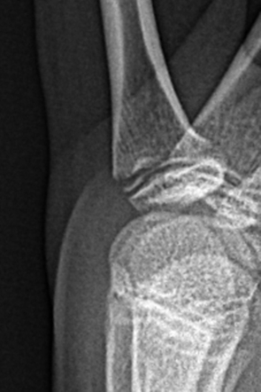 Salter Harris Type Ii Fracture Proximal Phalanx Radiology Case Radiopaedia Org