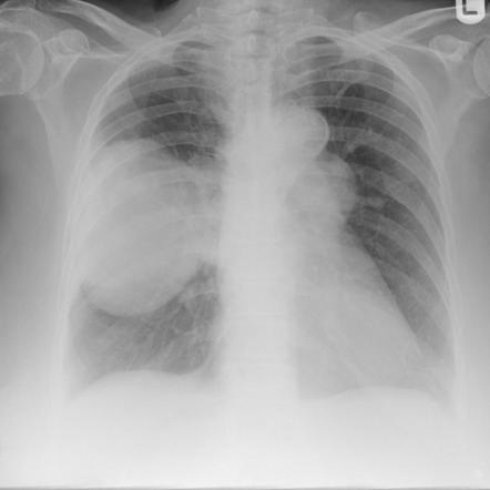 Pleural Fibroma 