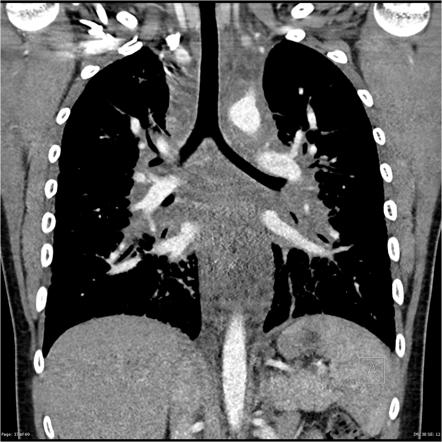 Lymphangiomatosis | Radiology Reference Article | Radiopaedia.org