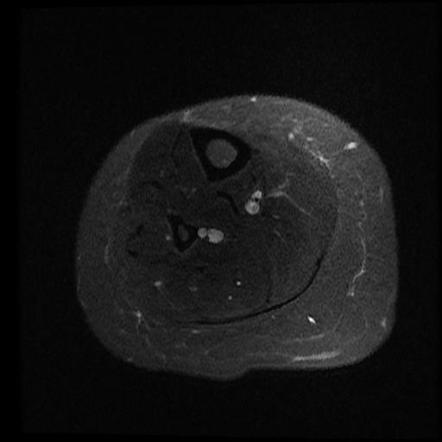 Fatty replacement of the gastrocnemius muscle belly | Image ...