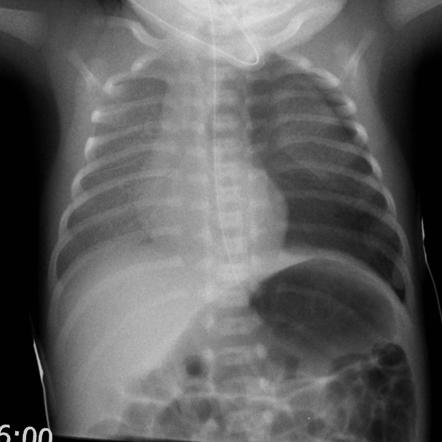 Neonatal tension pneumonthoax | Radiology Case | Radiopaedia.org