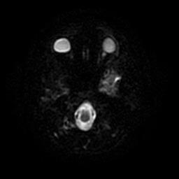 Cerebellopontine angle arachnoid cyst | Image | Radiopaedia.org