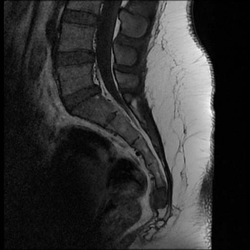 Isolated lower segment transverse sacral fracture | Image | Radiopaedia.org