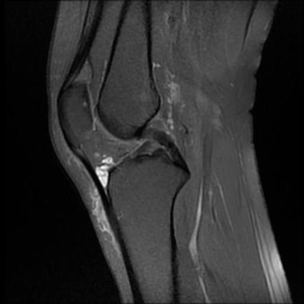 Hoffa's fat pad ganglion cyst | Radiology Case | Radiopaedia.org